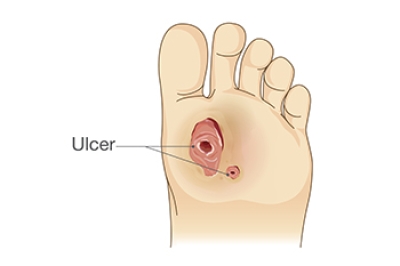 Staying Abreast of Diabetic Foot Ulcer Treatments