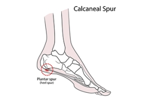 A Hidden Cause Behind Persistent Heel Pain