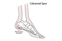A Hidden Cause Behind Persistent Heel Pain