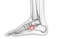 Risk Factors for Developing Cuboid Syndrome