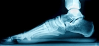 Understanding the Progression of Flat Feet in Adults