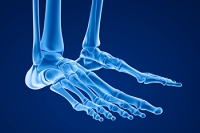Freiberg Infraction and Foot Pain