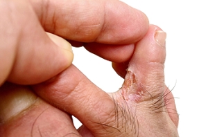 Athlete’s Foot Usually Clears up With Proper Care